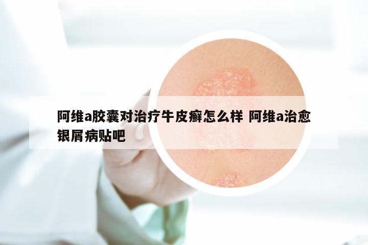 阿维a胶囊对治疗牛皮癣怎么样 阿维a治愈银屑病贴吧
