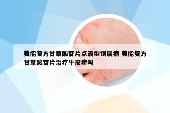 美能复方甘草酸苷片点滴型银屑病 美能复方甘草酸苷片治疗牛皮癣吗