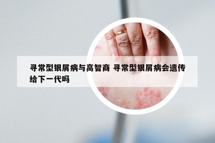 寻常型银屑病与高智商 寻常型银屑病会遗传给下一代吗