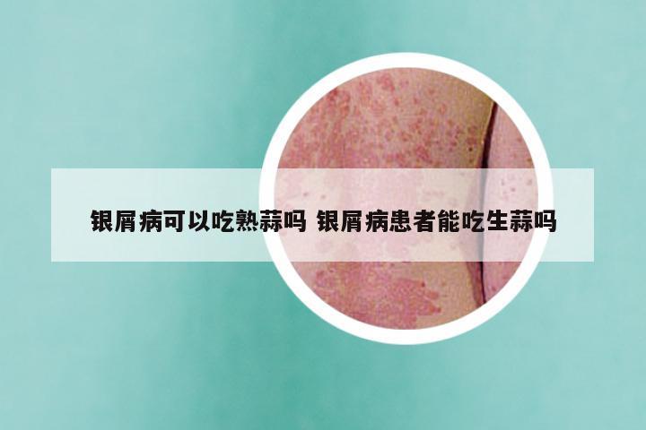 银屑病可以吃熟蒜吗 银屑病患者能吃生蒜吗