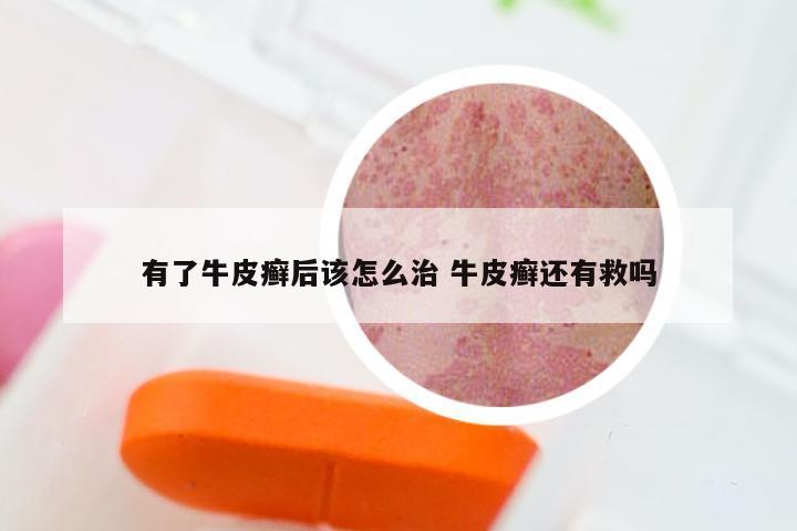 有了牛皮癣后该怎么治 牛皮癣还有救吗