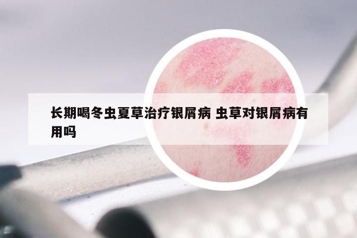 长期喝冬虫夏草治疗银屑病 虫草对银屑病有用吗