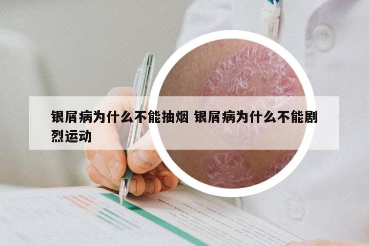 银屑病为什么不能抽烟 银屑病为什么不能剧烈运动