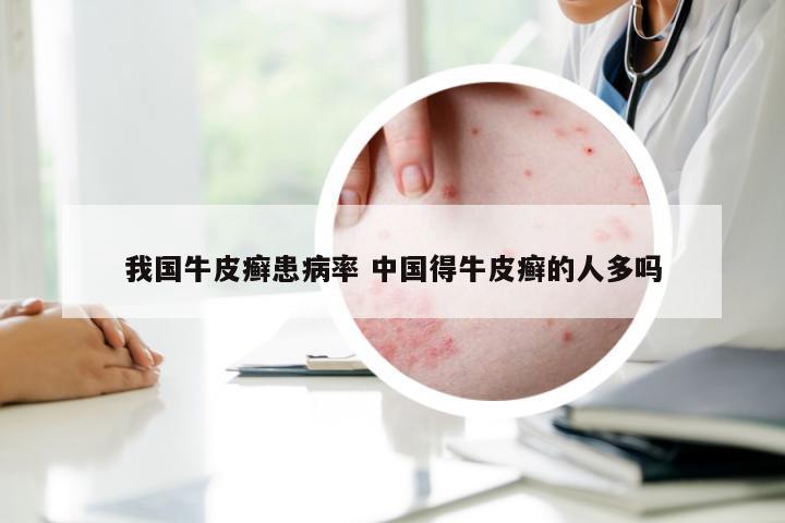 我国牛皮癣患病率 中国得牛皮癣的人多吗