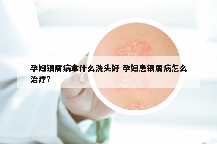 孕妇银屑病拿什么洗头好 孕妇患银屑病怎么治疗?