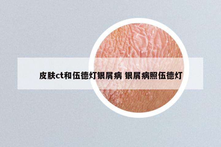皮肤ct和伍德灯银屑病 银屑病照伍德灯