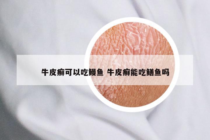 牛皮癣可以吃鳗鱼 牛皮癣能吃鳝鱼吗