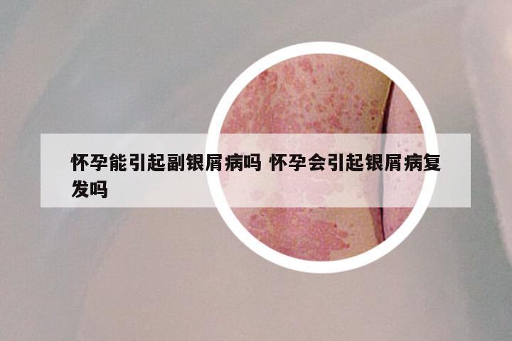 怀孕能引起副银屑病吗 怀孕会引起银屑病复发吗