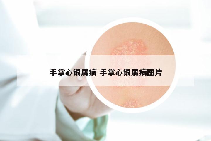 手掌心银屑病 手掌心银屑病图片