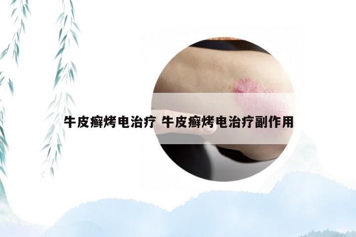 牛皮癣烤电治疗 牛皮癣烤电治疗副作用