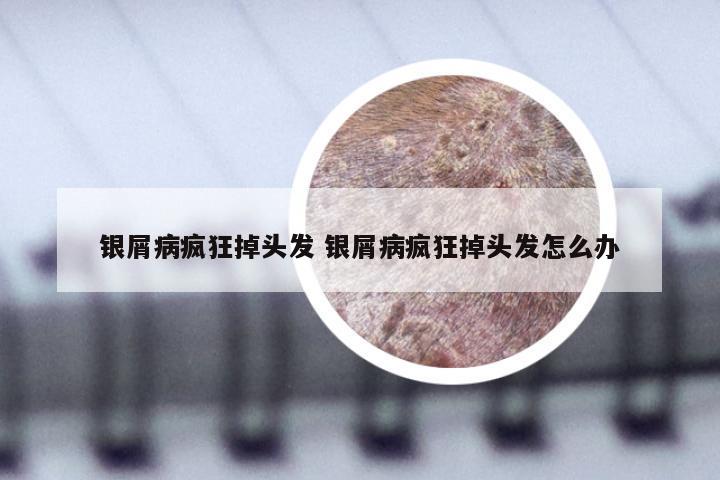 银屑病疯狂掉头发 银屑病疯狂掉头发怎么办