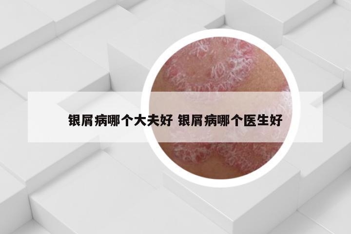 银屑病哪个大夫好 银屑病哪个医生好