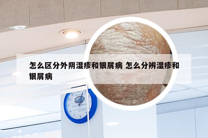 怎么区分外阴湿疹和银屑病 怎么分辨湿疹和银屑病