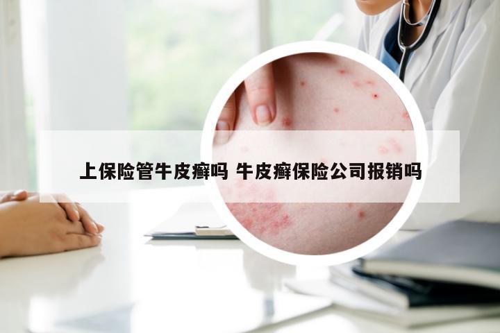 上保险管牛皮癣吗 牛皮癣保险公司报销吗