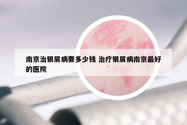 南京治银屑病要多少钱 治疗银屑病南京最好的医院