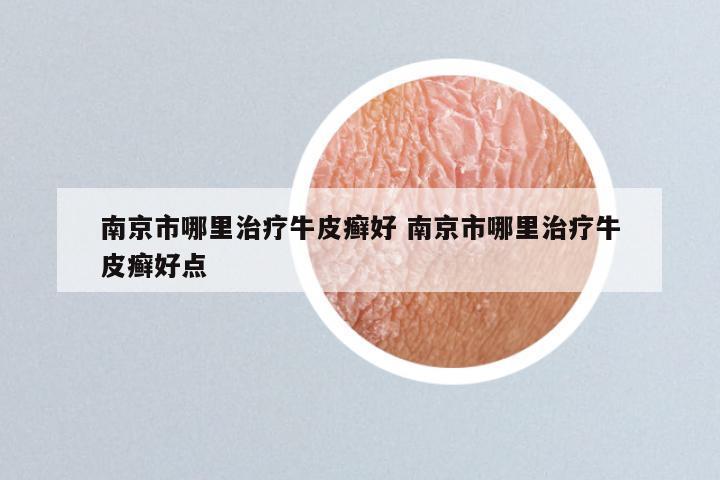 南京市哪里治疗牛皮癣好 南京市哪里治疗牛皮癣好点