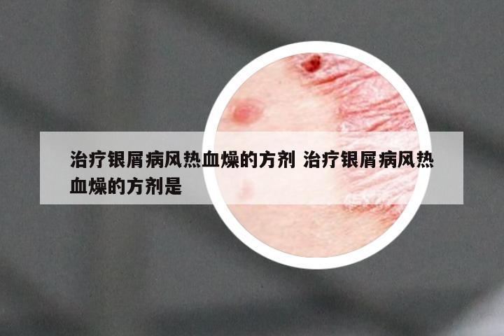 治疗银屑病风热血燥的方剂 治疗银屑病风热血燥的方剂是