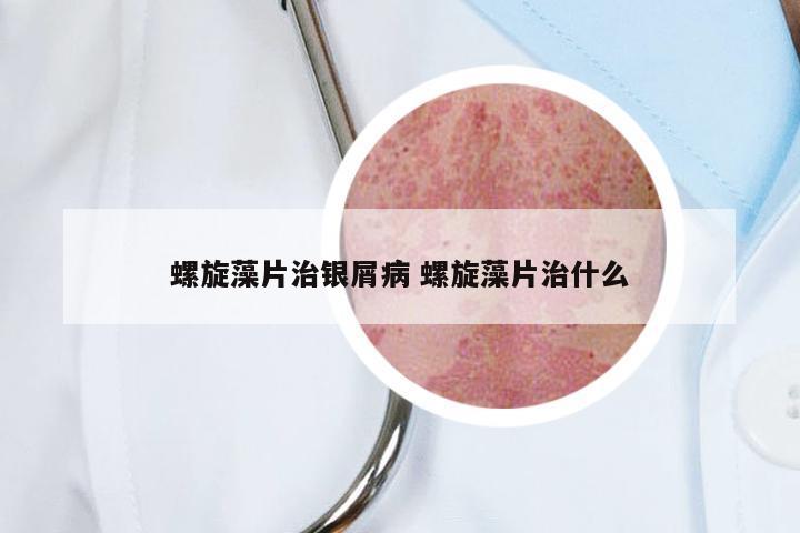 螺旋藻片治银屑病 螺旋藻片治什么