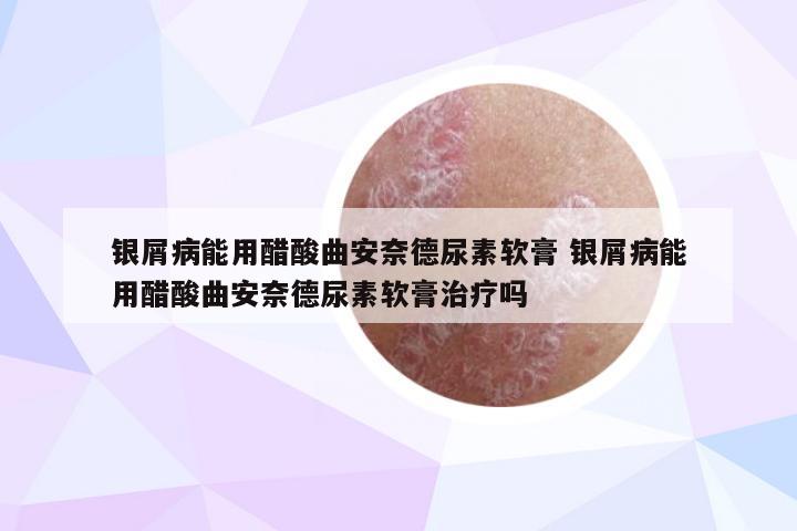 银屑病能用醋酸曲安奈德尿素软膏 银屑病能用醋酸曲安奈德尿素软膏治疗吗