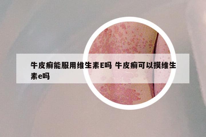 牛皮癣能服用维生素E吗 牛皮癣可以摸维生素e吗