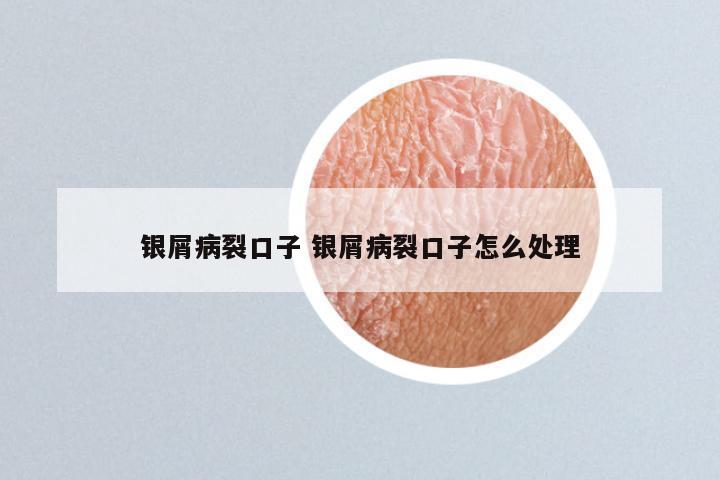 银屑病裂口子 银屑病裂口子怎么处理