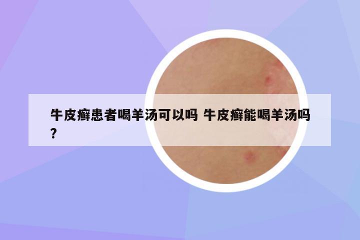 牛皮癣患者喝羊汤可以吗 牛皮癣能喝羊汤吗?