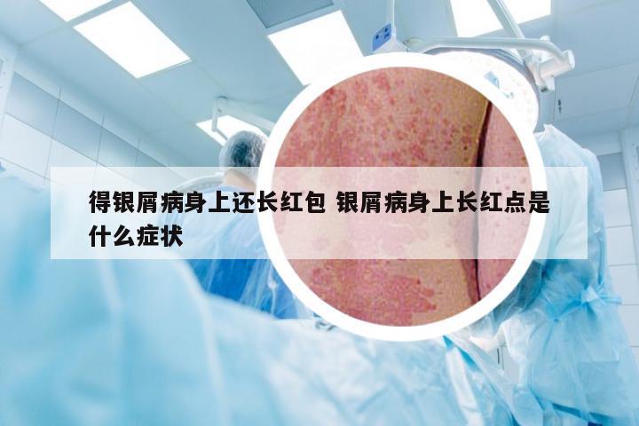 得银屑病身上还长红包 银屑病身上长红点是什么症状