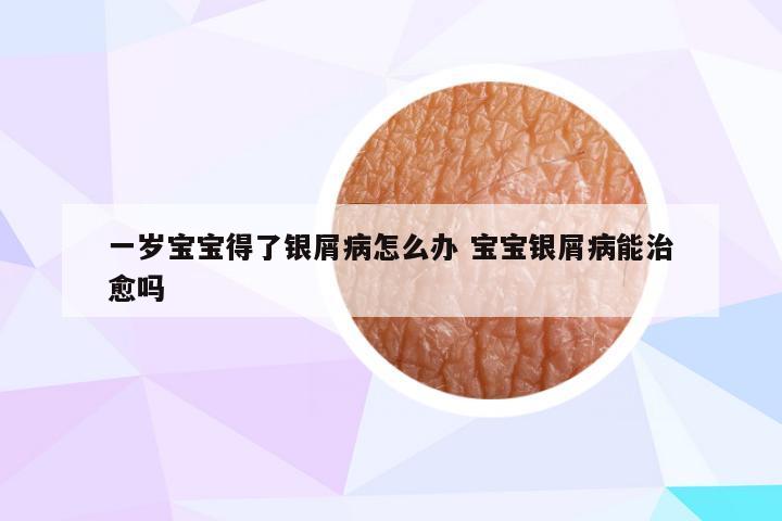 一岁宝宝得了银屑病怎么办 宝宝银屑病能治愈吗