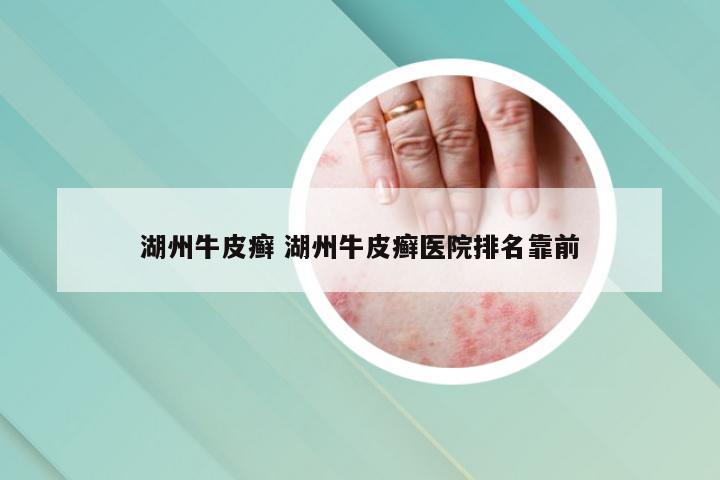 湖州牛皮癣 湖州牛皮癣医院排名靠前