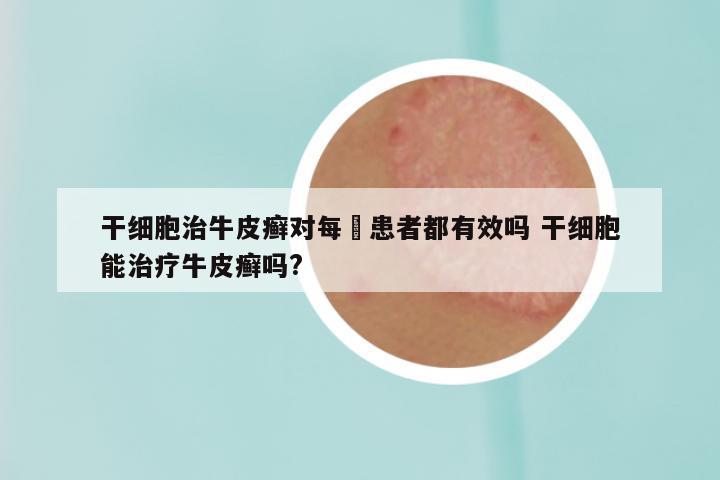干细胞治牛皮癣对每亇患者都有效吗 干细胞能治疗牛皮癣吗?
