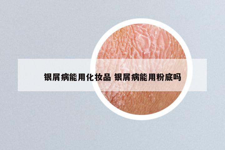 银屑病能用化妆品 银屑病能用粉底吗