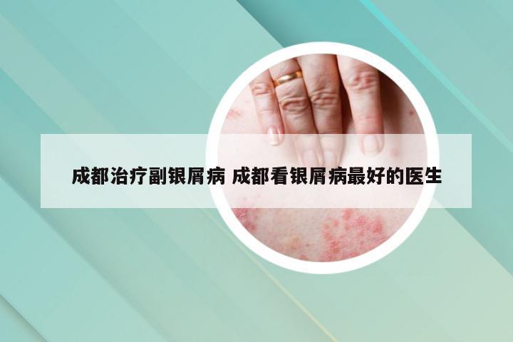 成都治疗副银屑病 成都看银屑病最好的医生