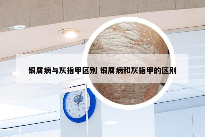 银屑病与灰指甲区别 银屑病和灰指甲的区别