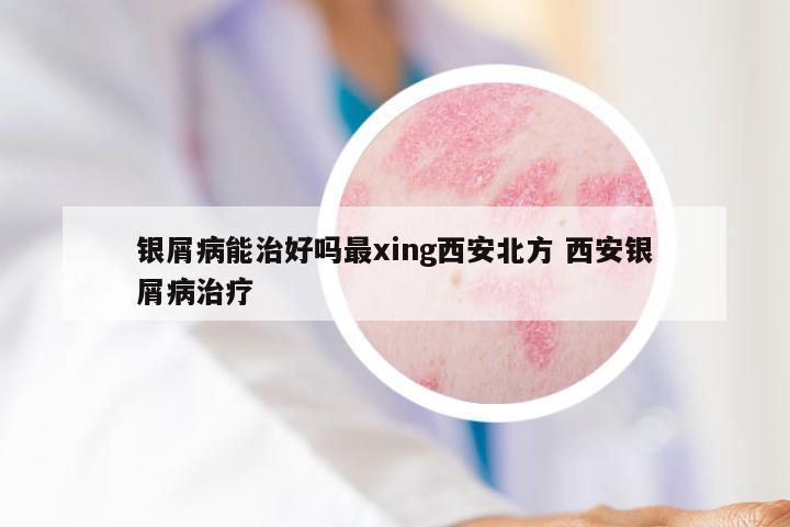 银屑病能治好吗最xing西安北方 西安银屑病治疗