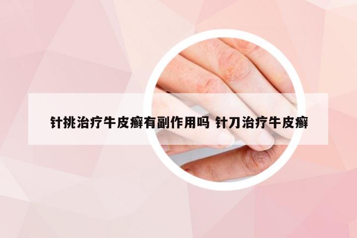 针挑治疗牛皮癣有副作用吗 针刀治疗牛皮癣