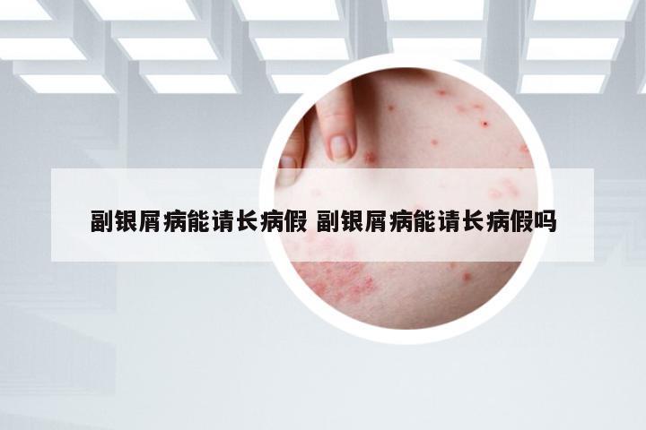 副银屑病能请长病假 副银屑病能请长病假吗