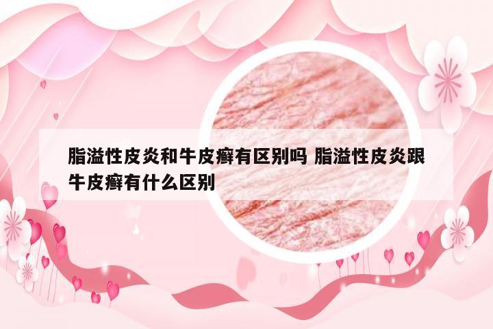 脂溢性皮炎和牛皮癣有区别吗 脂溢性皮炎跟牛皮癣有什么区别