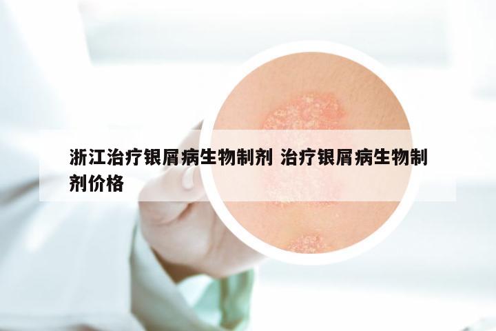 浙江治疗银屑病生物制剂 治疗银屑病生物制剂价格