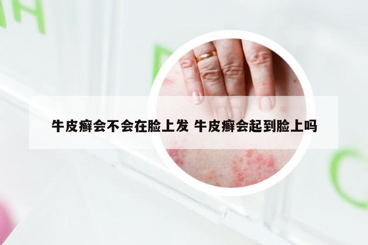 牛皮癣会不会在脸上发 牛皮癣会起到脸上吗