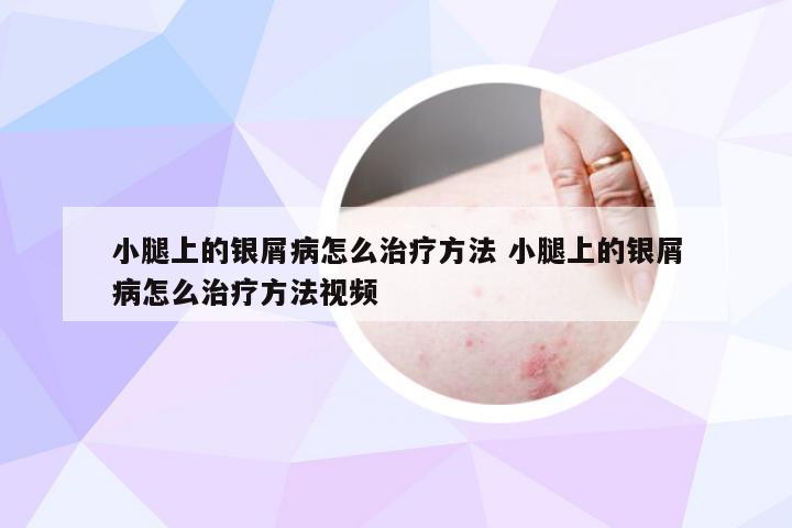 小腿上的银屑病怎么治疗方法 小腿上的银屑病怎么治疗方法视频