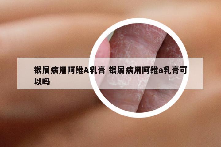银屑病用阿维A乳膏 银屑病用阿维a乳膏可以吗