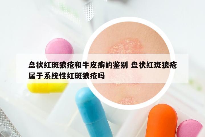 盘状红斑狼疮和牛皮癣的鉴别 盘状红斑狼疮属于系统性红斑狼疮吗