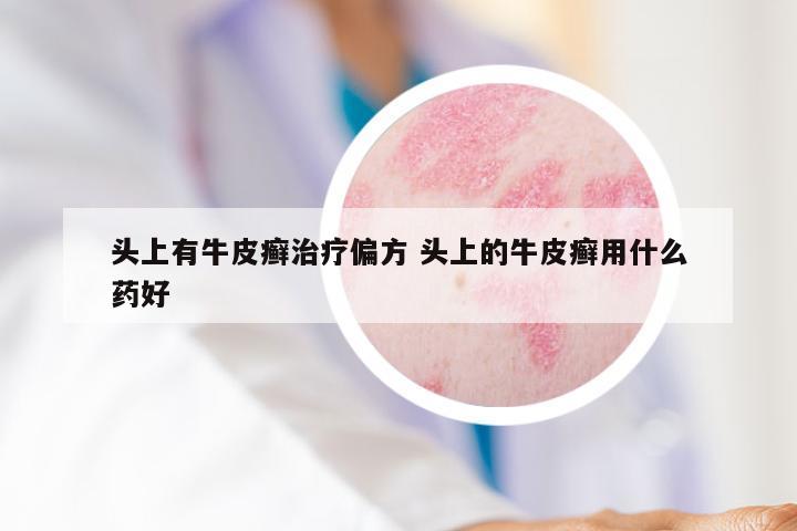 头上有牛皮癣治疗偏方 头上的牛皮癣用什么药好