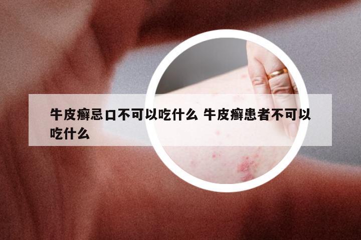 牛皮癣忌口不可以吃什么 牛皮癣患者不可以吃什么