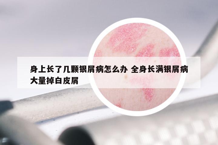 身上长了几颗银屑病怎么办 全身长满银屑病大量掉白皮屑