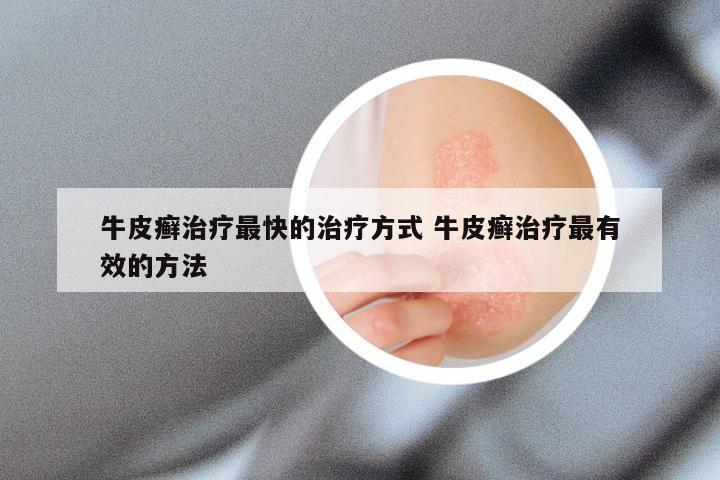 牛皮癣治疗最快的治疗方式 牛皮癣治疗最有效的方法