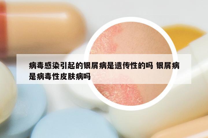 病毒感染引起的银屑病是遗传性的吗 银屑病是病毒性皮肤病吗