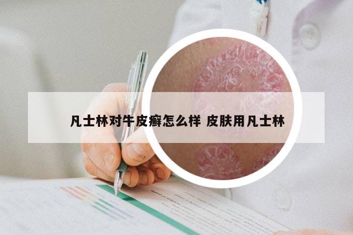 凡士林对牛皮癣怎么样 皮肤用凡士林