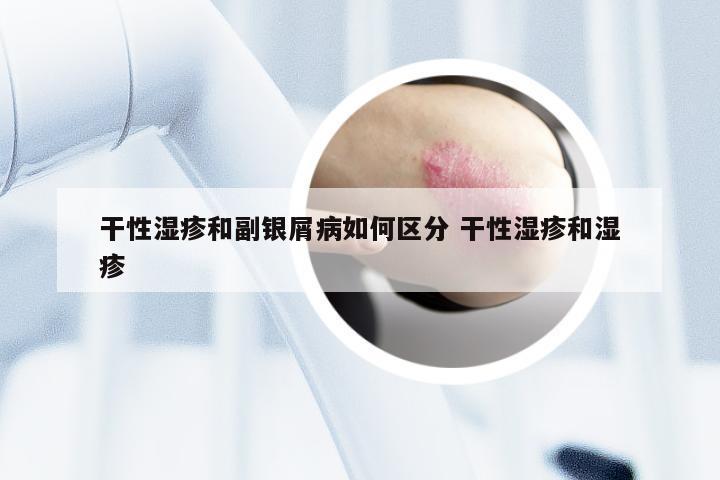 干性湿疹和副银屑病如何区分 干性湿疹和湿疹