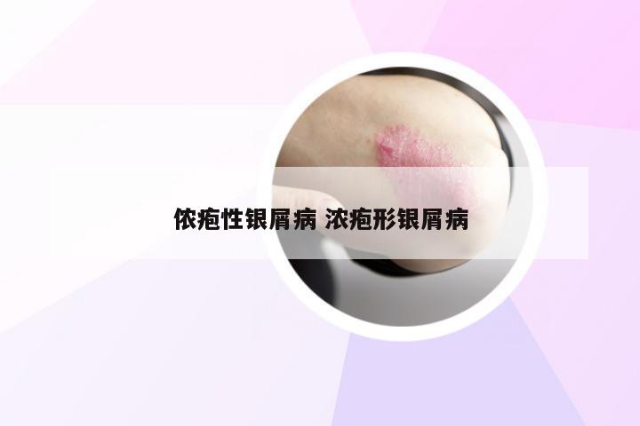 侬疱性银屑病 浓疱形银屑病